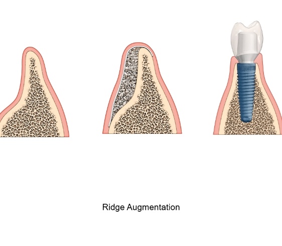 3D illustration of sinus lift surgery