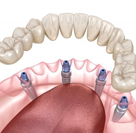Digital illustration of all-on-4 dental implants