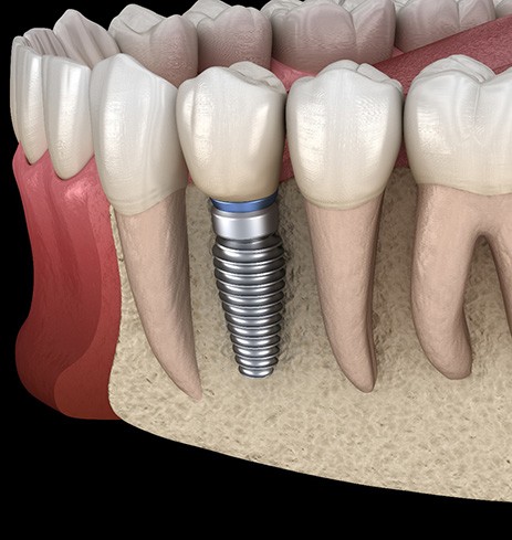 Illustration of dental implant in jaw after bone augmentation in Dumfries