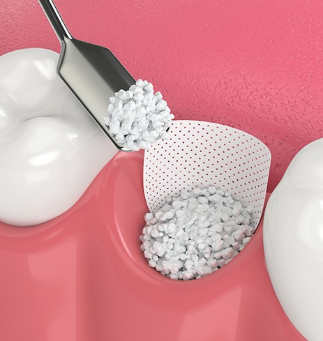 a 3D illustration showing the bone grafting process