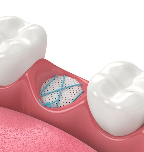 a 3D illustration showing bone grafting after a tooth extraction