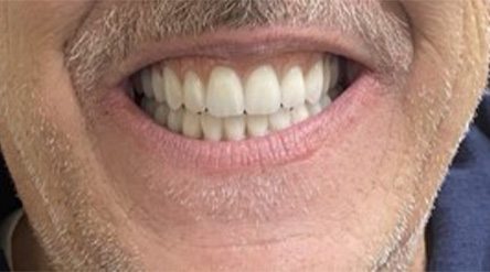 Smile with newly replaced bottom tooth