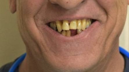 Smile with missing bottom tooth
