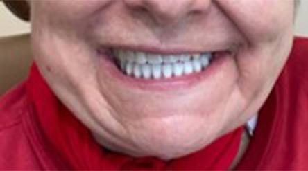 Smile with newly replaced bottom tooth