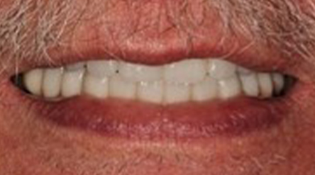 Smile with newly replaced bottom tooth