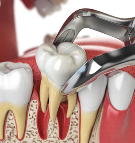 Illustration of forceps holding extracted tooth