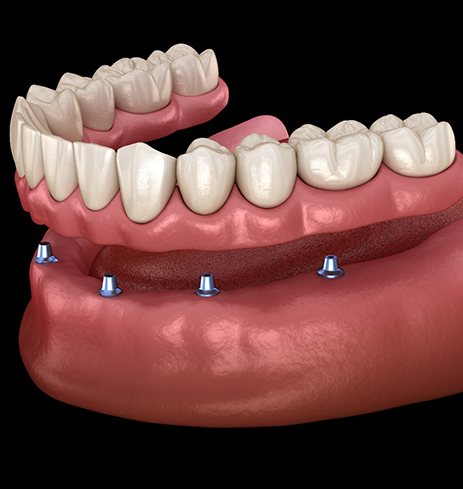 Digital illustration of implant dentures in Dumfries