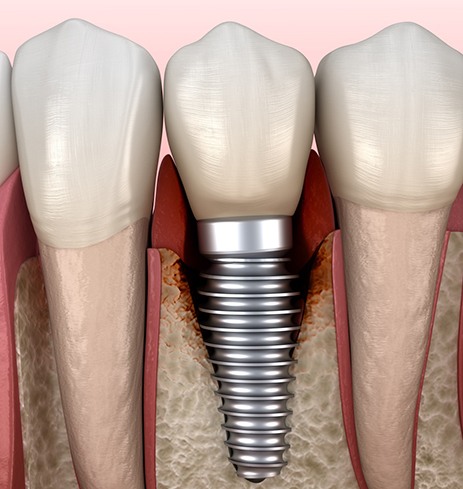 Illustration of peri-implantitis, a common cause of dental implant failure