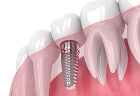 Render of a dental implant in Dumfries, VA with antibacterial coating