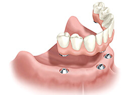 Animated dental implant supported denture placement