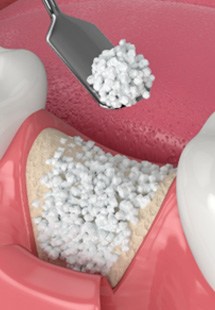 Illustration of bone grafting