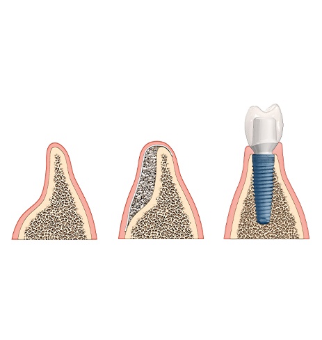 Animated bone augmentation process