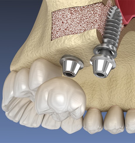 Animated smile during sinus lift procedure