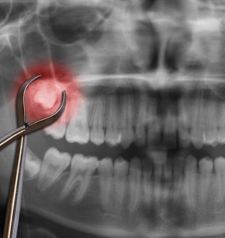 Smile with impacted canine