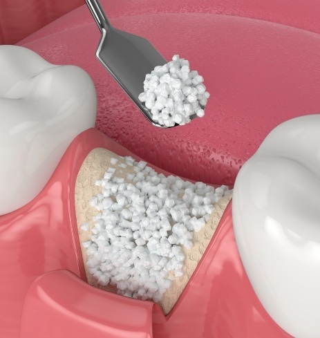 Animated smile during bone grafting treatment