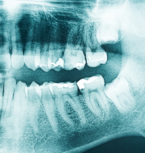 All digital x-rays of damaged smile