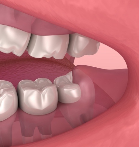 Animated smile with impacted wisdom tooth