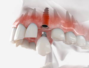 Illustration of a dental implant for the upper arch