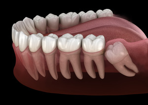 Illustration of an impacted wisdom tooth in the lower arch