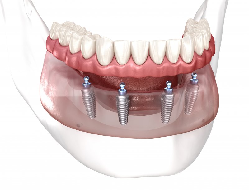 a 3D illustration of All-On-4 dental implants