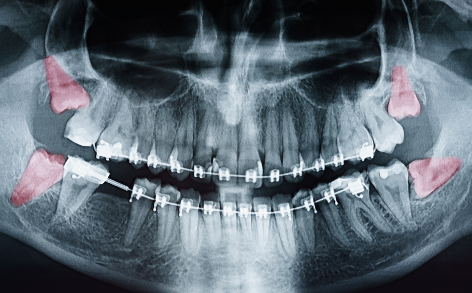 X-ray showing sideways wisdom teeth