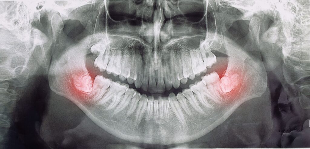 X-ray with two lower wisdom teeth highlighted red